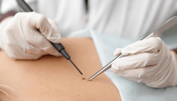 Caratteristiche della rimozione del papilloma