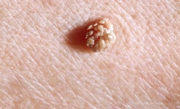 Papilloma sul corpo umano