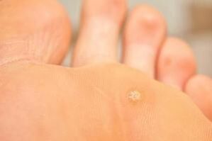 Perché compaiono le verruche plantari